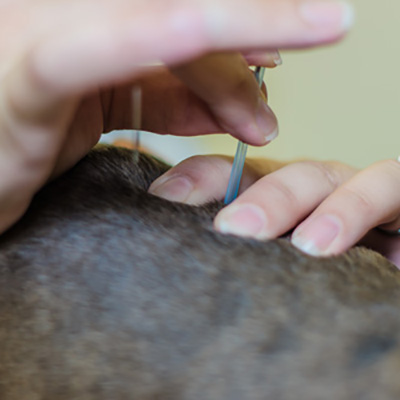 Acupuncture