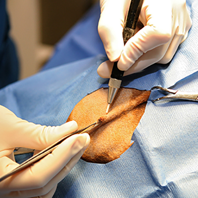 Laser Surgery